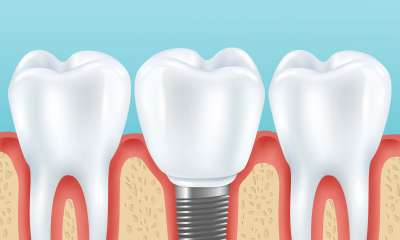 Zubni implantati - što je i kako izgleda proces ugradnje?