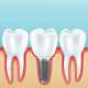 Zubni implantati - što je i kako izgleda proces ugradnje?