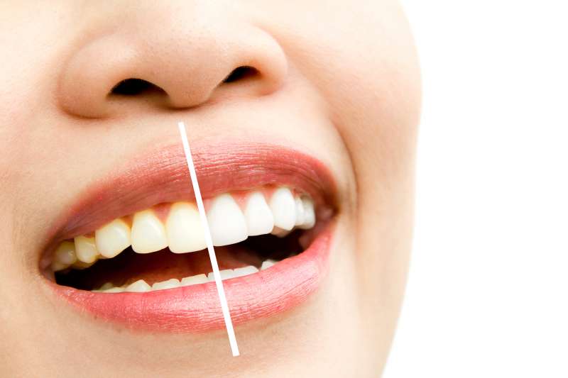 Je li izbjeljivanje zuba štetno