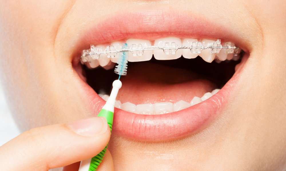 INTERDENTALNE ČETKICE: Dostojna zamjena za zubni konac?