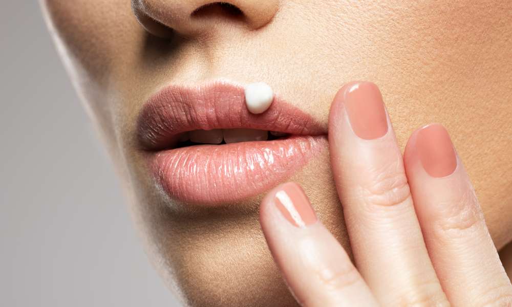 Herpes na usni – simptomi, uzroci, liječenje i komplikacije