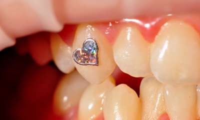 Je li nakit za zube opasan po zdravlje?