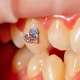 Je li nakit za zube opasan po zdravlje?