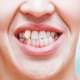 Imaju li Britanci zaista loše zube?